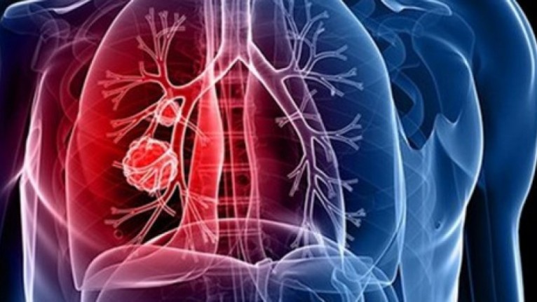 Akciğerde sorun yaşandığını gösteren bu 5 belirtiye dikkat! Akciğerler bu şekilde uyarıyor